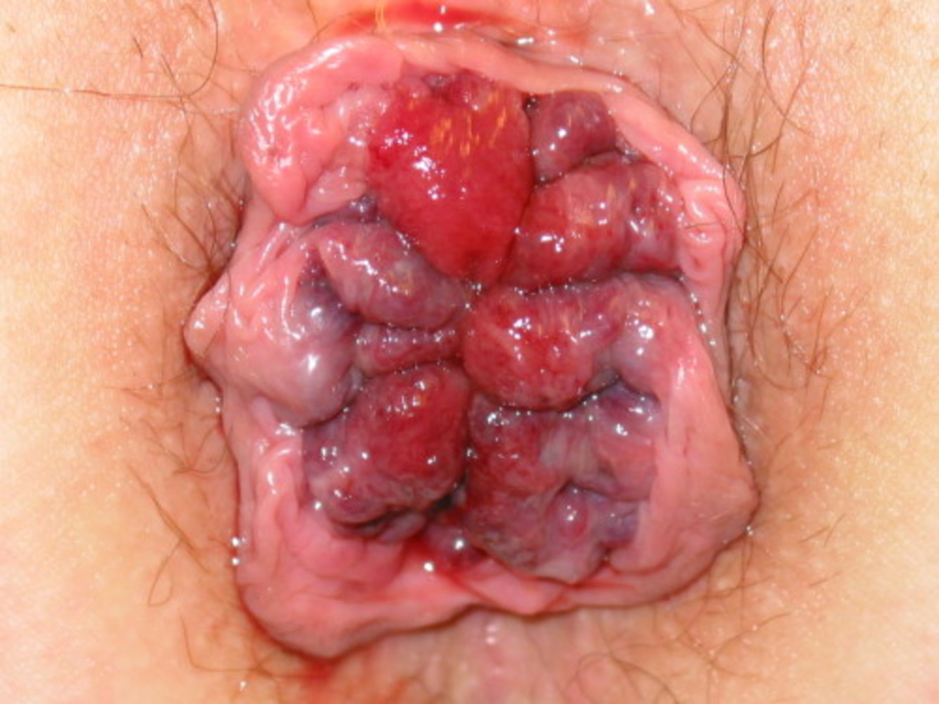 anal plug hemorrhoids Wasserbasiertes Gleitgel – nevernot.de