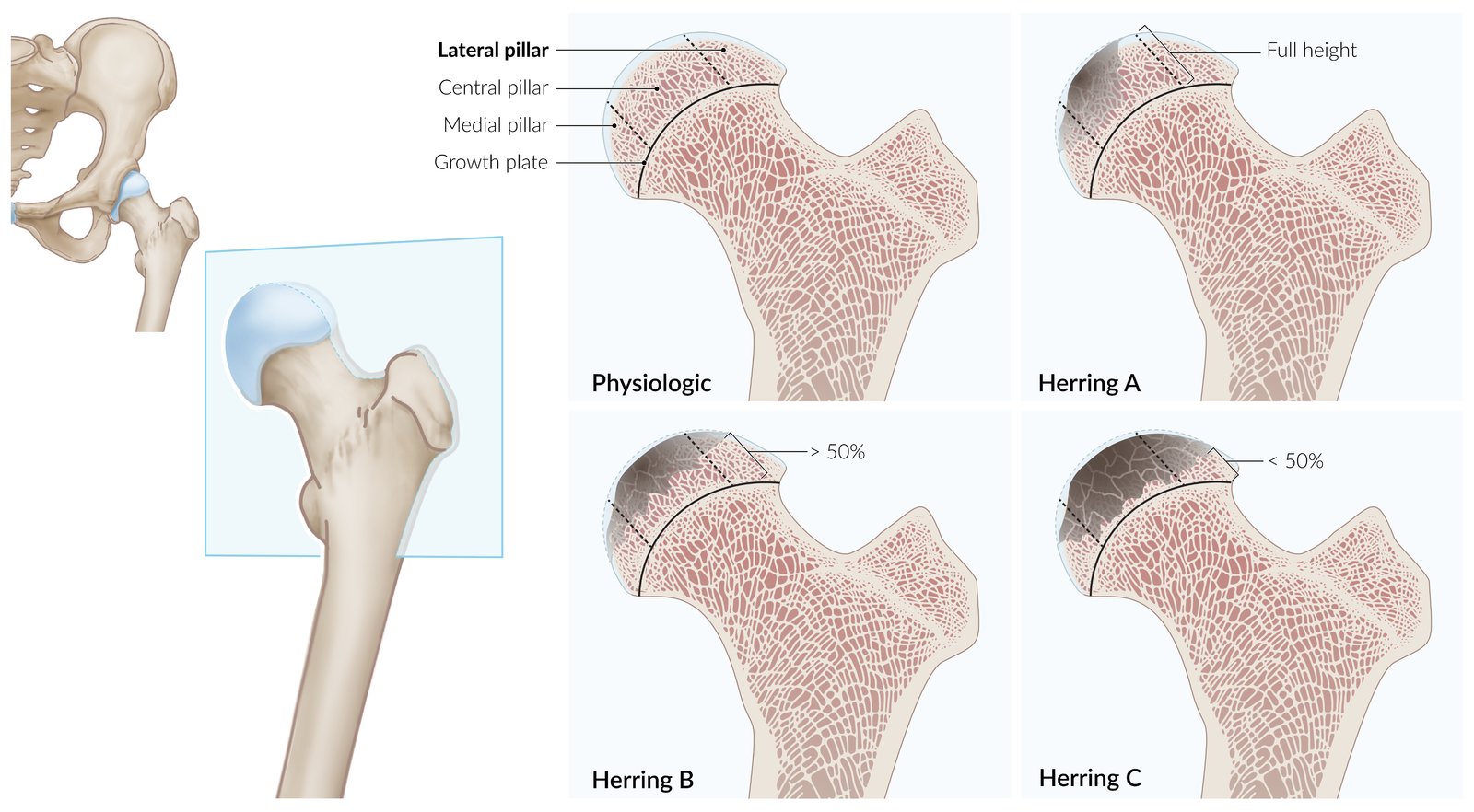 Legg-Calvé-Perthes disease - Knowledge @ AMBOSS, image size:1600x882