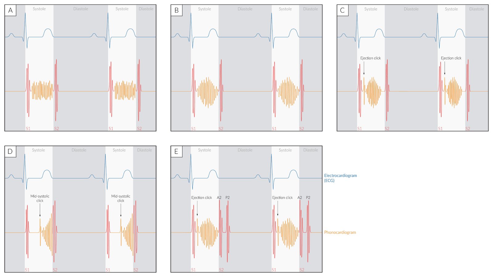 Valvular heart diseases - Knowledge @ AMBOSS