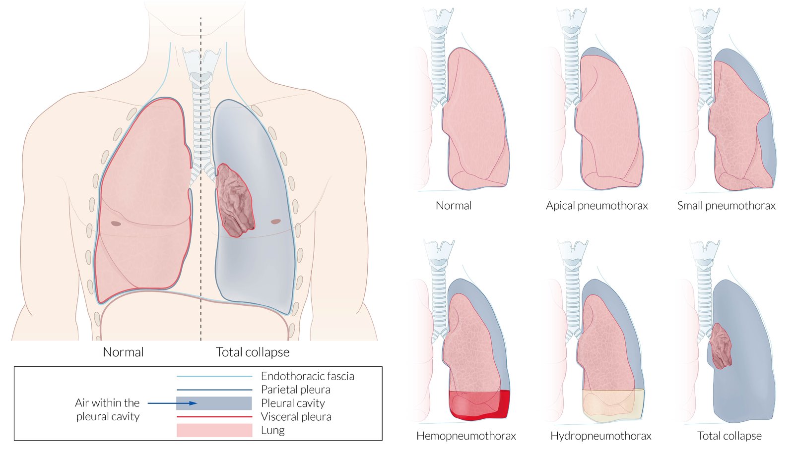 Diagram Of Open Pneumothorax Tension Pneumothorax