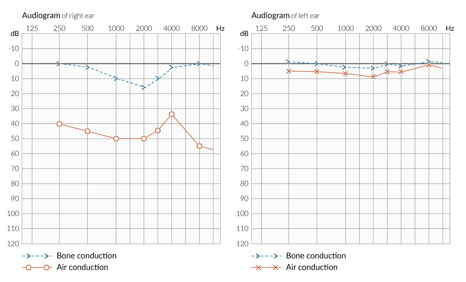 Audiogram Sensorineural Hearing Loss How To Read Your Hearing Test