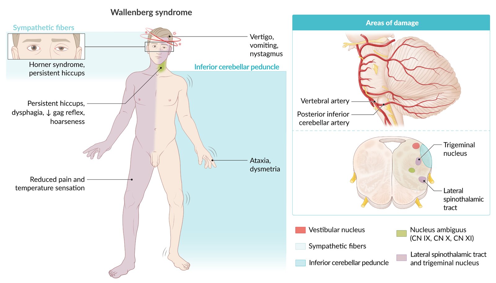 Wallenberg Syndroom Dissection Of The Internal Carotid Artery Causing