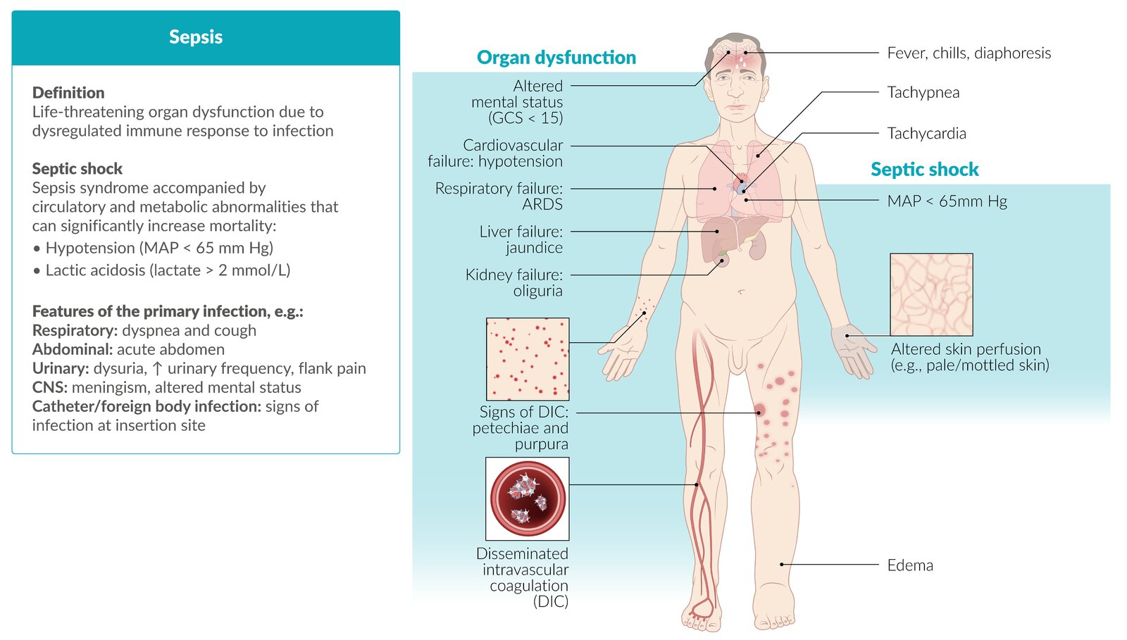 Sepsis - Knowledge @ AMBOSS