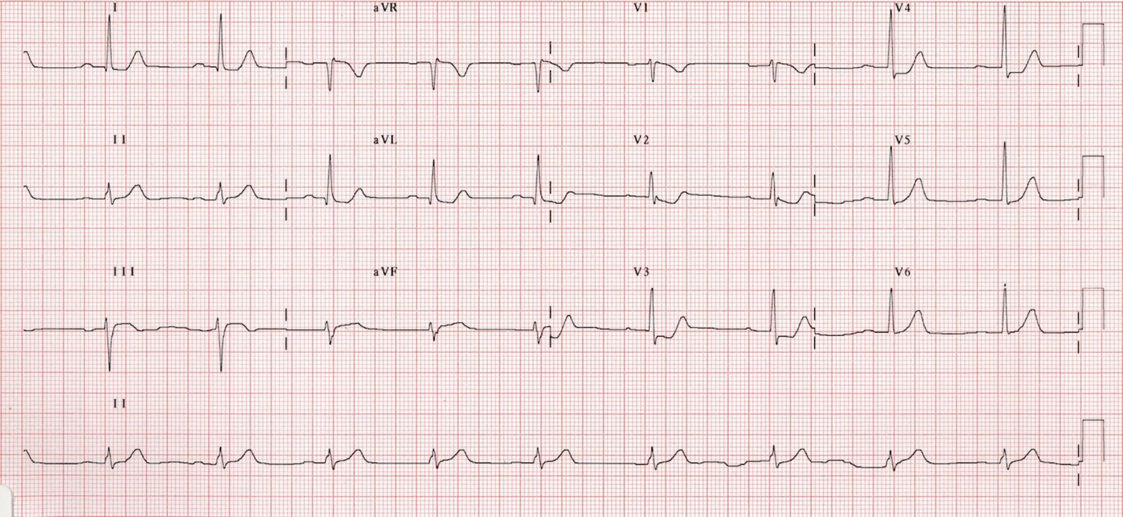 Mi Ecg Changes Timeline