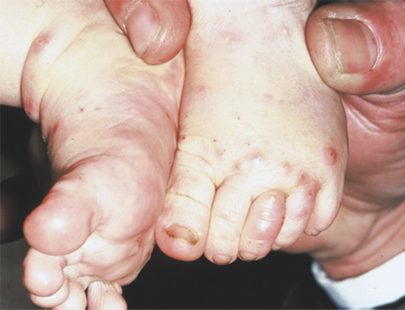 Scabies Burrows On Feet