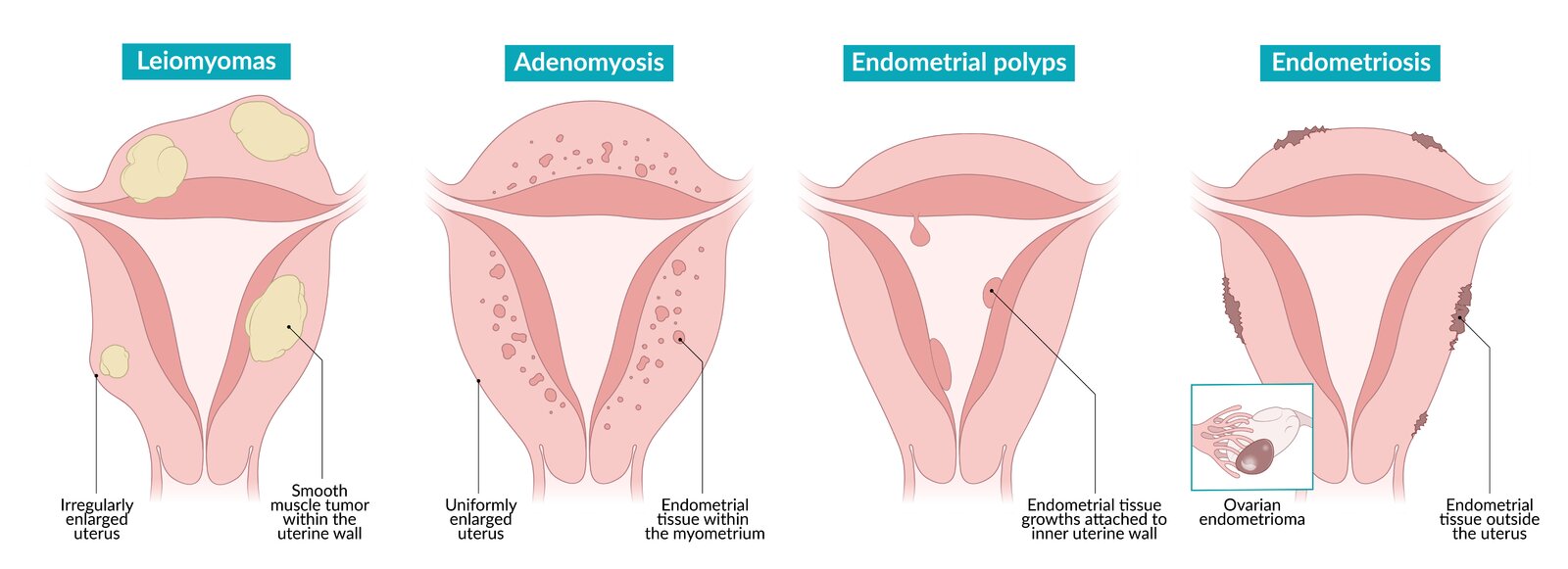 Emerging treatment options for uterine fibroids, image size:1600x581