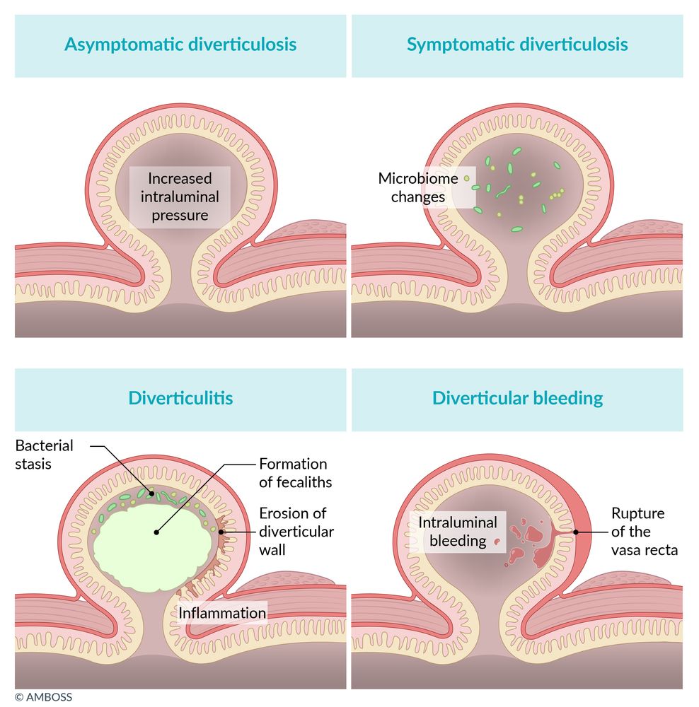 semaglutide and diverticulitis Small bowel diverticular disease