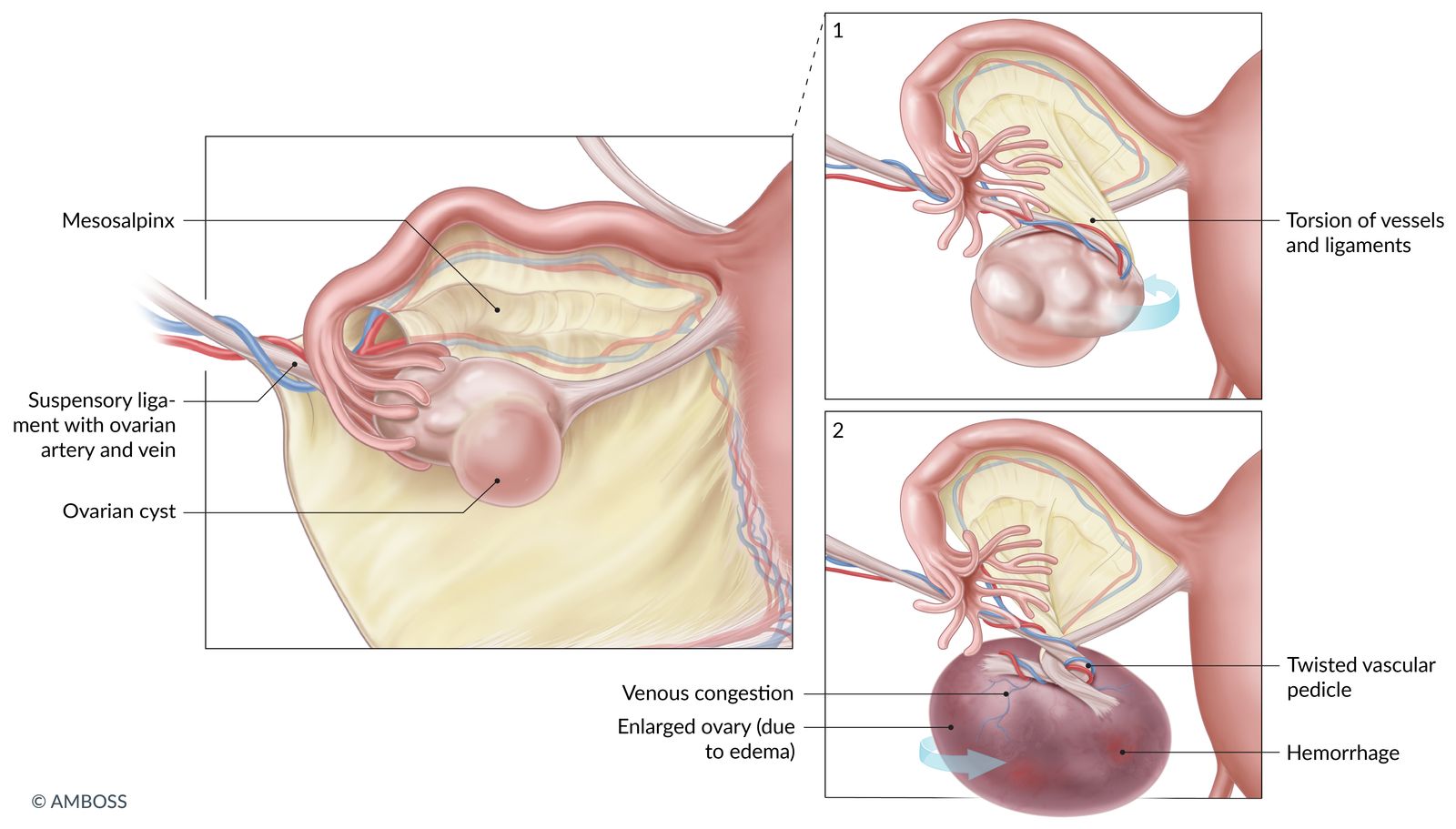 Ovarian cysts
