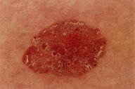 Cutaneous squamous cell carcinoma - Knowledge @ AMBOSS