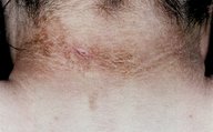 Acanthosis nigricans - Knowledge @ AMBOSS