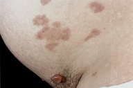 Hyperpigmentation disorders - Knowledge @ AMBOSS