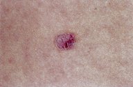 Basal cell carcinoma - Knowledge @ AMBOSS