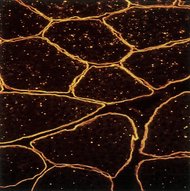 Progressive muscular dystrophies - Knowledge @ AMBOSS