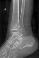 Ankle fracture - Knowledge @ AMBOSS