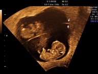 Multifetal gestation - Knowledge @ AMBOSS