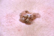 Cutaneous squamous cell carcinoma - Knowledge @ AMBOSS