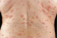 Pityriasis rosea - Knowledge @ AMBOSS