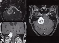 Acoustic neuroma - Knowledge @ AMBOSS
