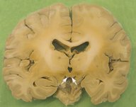 Wernicke encephalopathy and Korsakoff syndrome - Knowledge @ AMBOSS