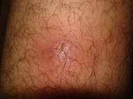 Skin and soft tissue infections - Knowledge @ AMBOSS