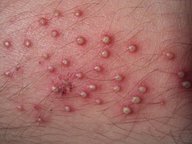 Skin and soft tissue infections - Knowledge @ AMBOSS