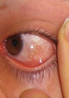 Overview of conjunctivitis - Knowledge @ AMBOSS