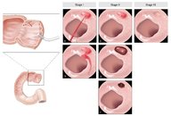 Peptic ulcer disease - Knowledge @ AMBOSS
