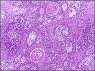 Cutaneous squamous cell carcinoma - Knowledge @ AMBOSS