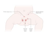 Scrotal abnormalities - Knowledge @ AMBOSS