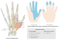 Carpal tunnel syndrome - Knowledge @ AMBOSS