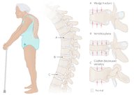 Vertebral injuries - Knowledge @ AMBOSS