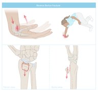 Forearm fractures - Knowledge @ AMBOSS