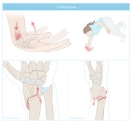 Radial head fracture PLUS disruption of the i nterosseous membrane of ...