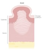 Hypertrophic scars and keloids - Knowledge @ AMBOSS