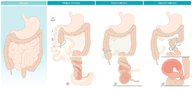 Sigmoid volvulus and cecal volvulus - Knowledge @ AMBOSS