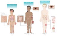 Juvenile idiopathic arthritis - Knowledge @ AMBOSS