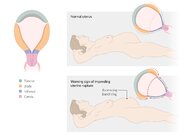 Uterine rupture - Knowledge @ AMBOSS