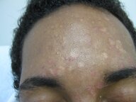 Pityriasis versicolor - Knowledge @ AMBOSS