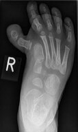 Toe deformities - Knowledge @ AMBOSS