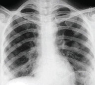 Gestational trophoblastic disease - Knowledge @ AMBOSS