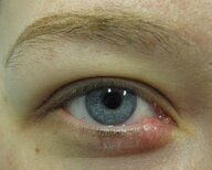 Inflammation of the eyelids - Knowledge @ AMBOSS