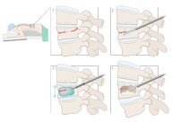 Vertebral injuries - Knowledge @ AMBOSS