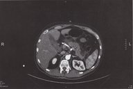 Acute pancreatitis - Knowledge @ AMBOSS