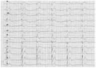 ECG - Knowledge @ AMBOSS