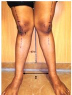 Angular deformities of the lower extremities - Knowledge @ AMBOSS