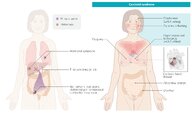 Carcinoid syndrome - Knowledge @ AMBOSS