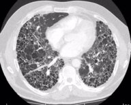 Interstitial lung diseases - Knowledge @ AMBOSS