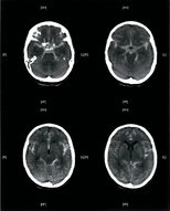 Subarachnoid hemorrhage - Knowledge @ AMBOSS
