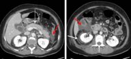 Acute pancreatitis - Knowledge @ AMBOSS