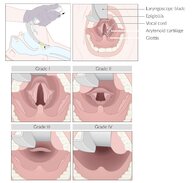 Airway management - Knowledge @ AMBOSS